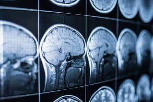 Studies Show That Traumatic Brain Injury Is a Chronic Disease