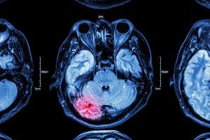 What Is a Secondary Brain Injury?