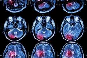 Traumatic Brain Injuries May Increase the Risk of Brain Tumors