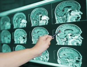 Catastrophic Brain Injuries in Ohio